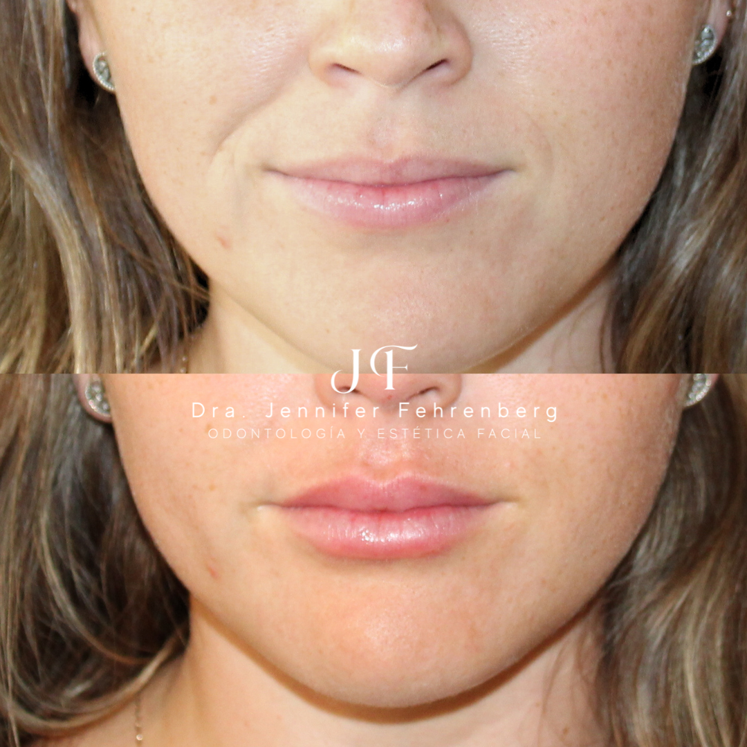 Armonización de Labios